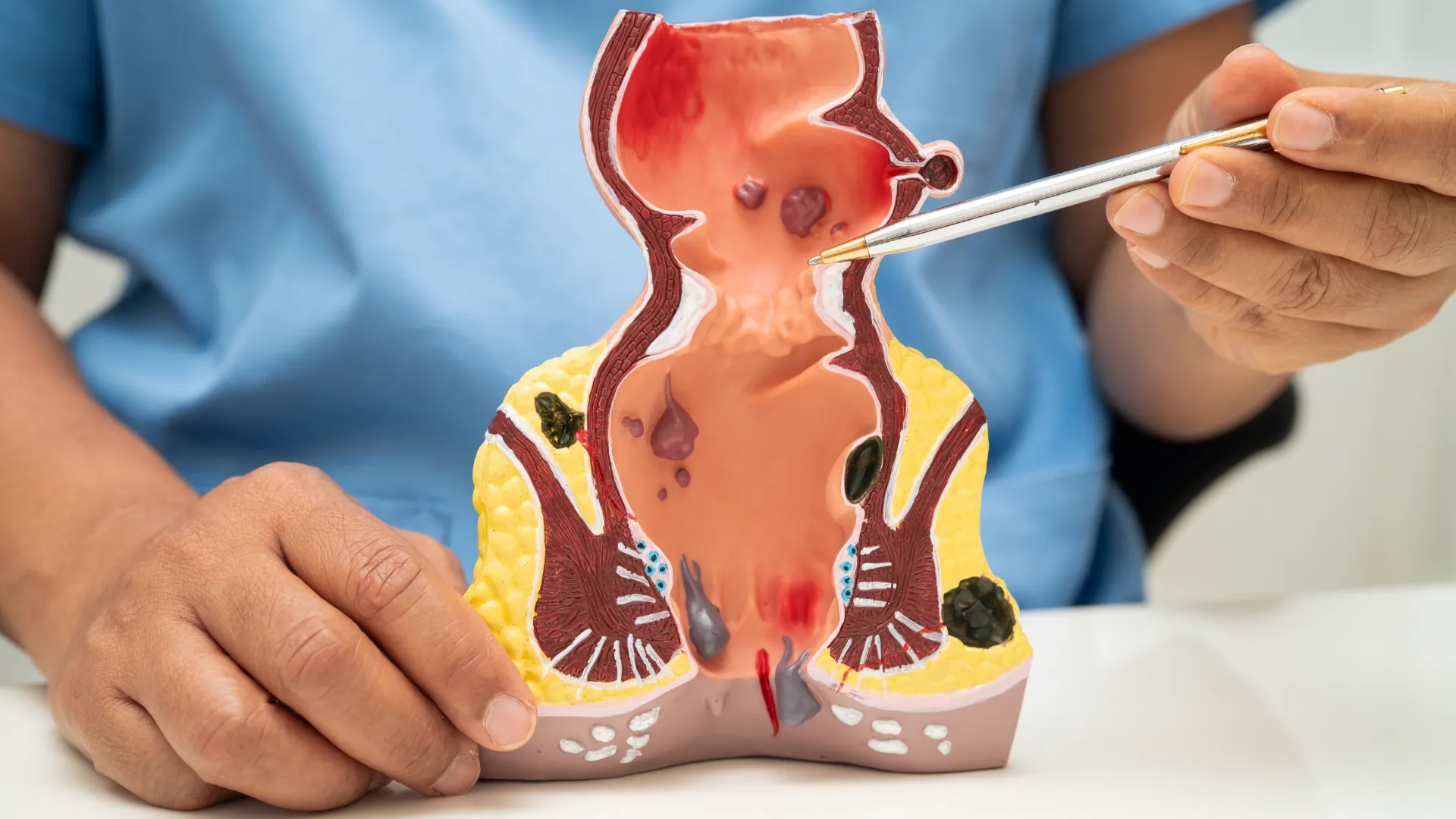 Hemorrhoid Treatment: What You Need to Know?