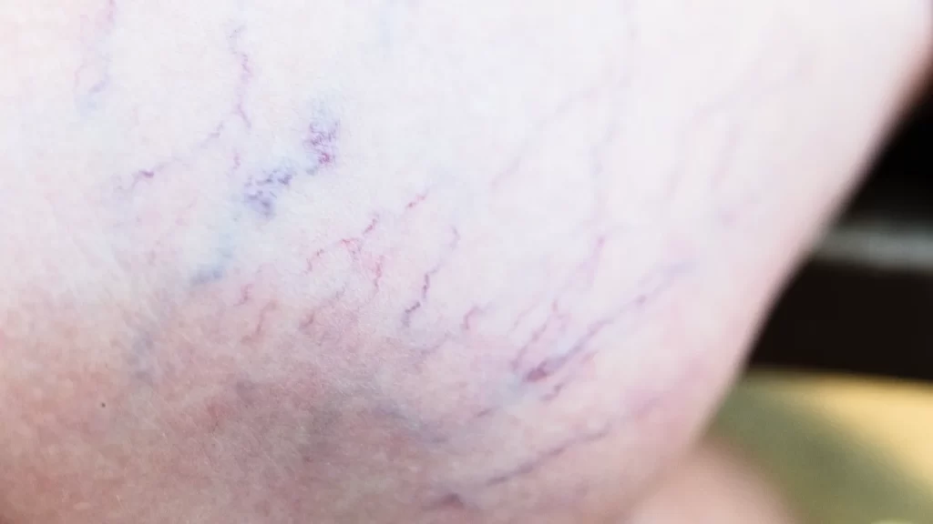 Varicose vein treatment